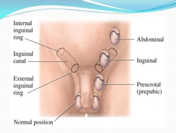 İnmemiş Testis